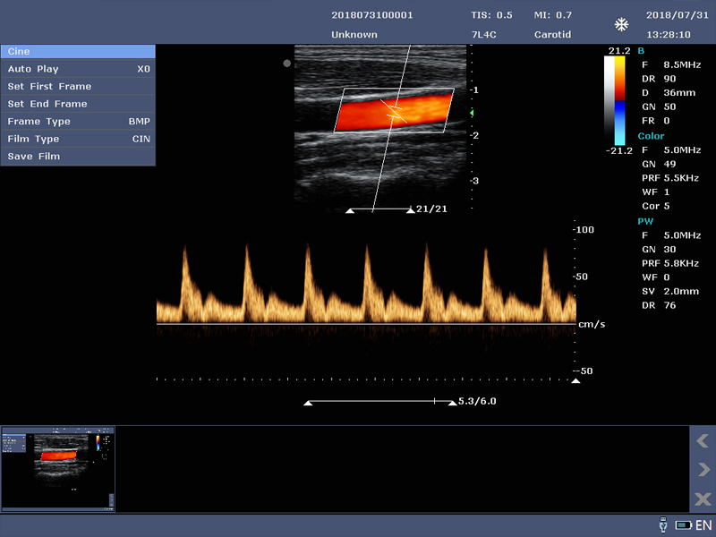 PW Carotid Artery Spectrum ultrasound machine