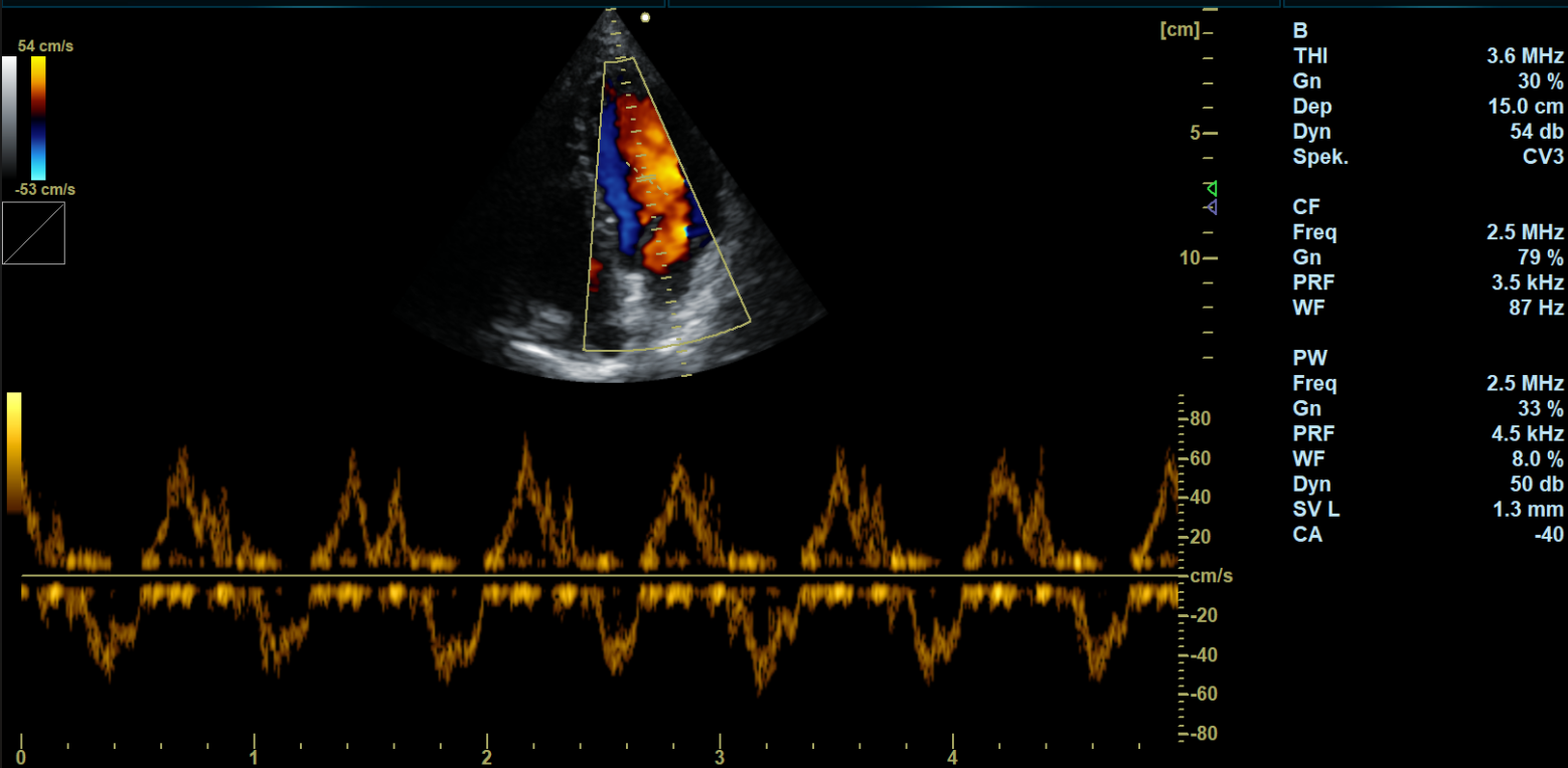 Cardiac-CF+PW-Mode