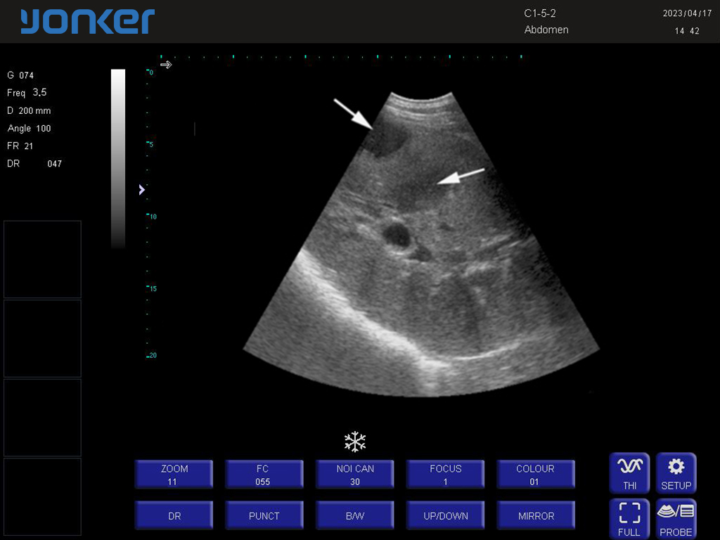 马-凸阵-B模式-肝脏 Convex Probe-B Mode- Right Liver 1