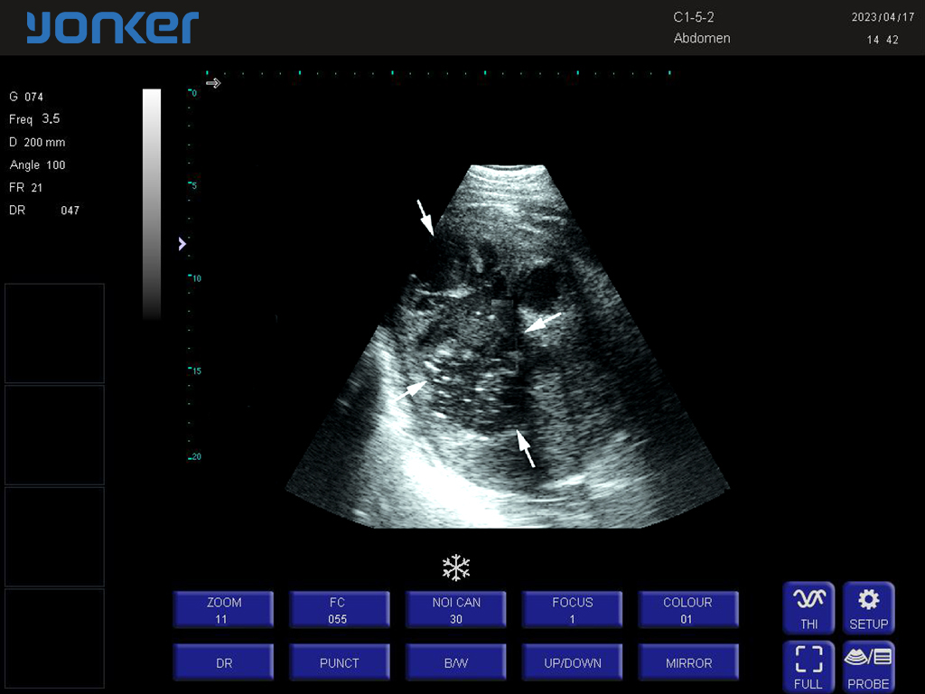 马-凸阵-B模式-肾脏 Convex Probe-B Mode- Right Kidney